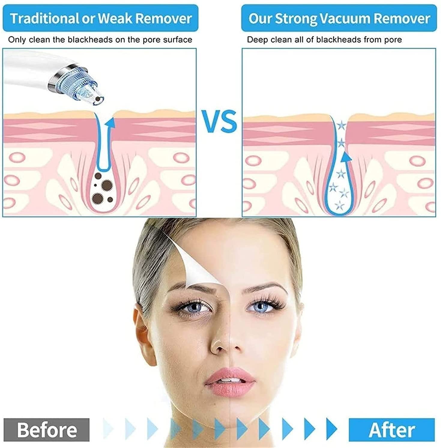 Adjustable Blackhead Pore Vacuum