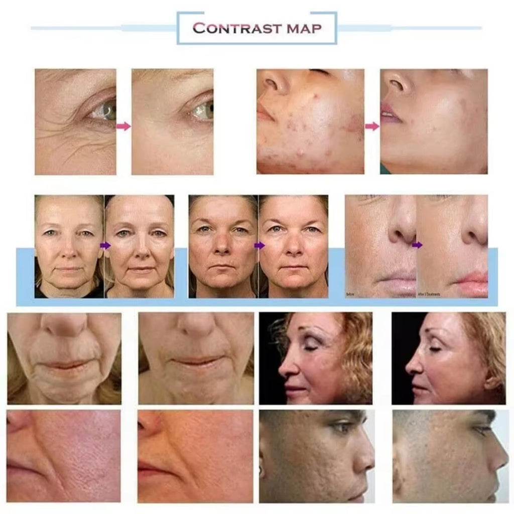 Facial and Body Skin Tightening Device