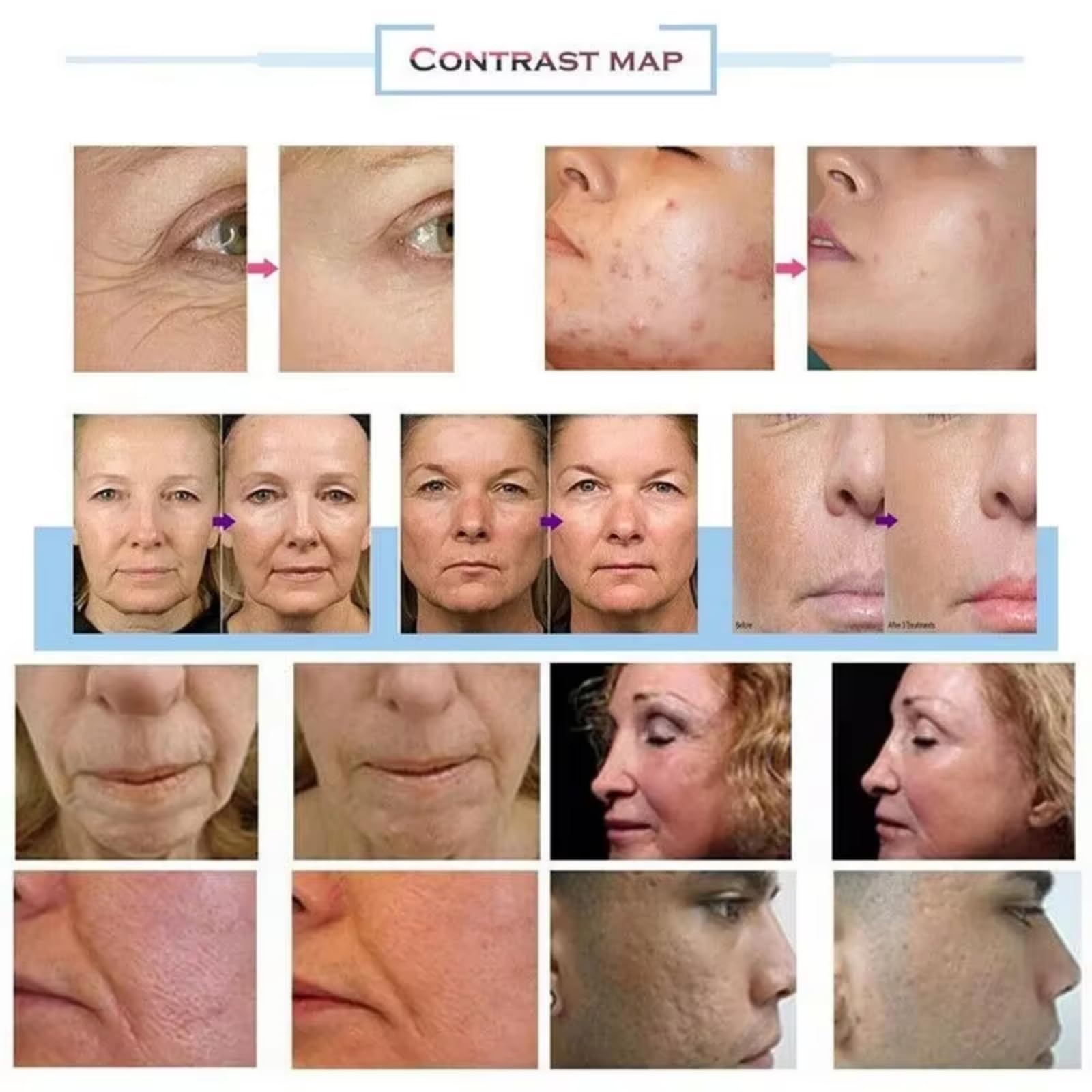 Facial and Body Skin Tightening Device
