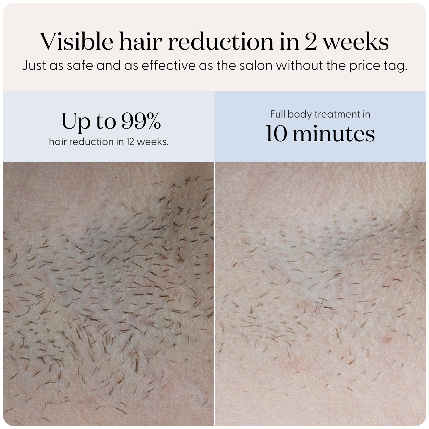 At-Home IPL Hair Removal Device